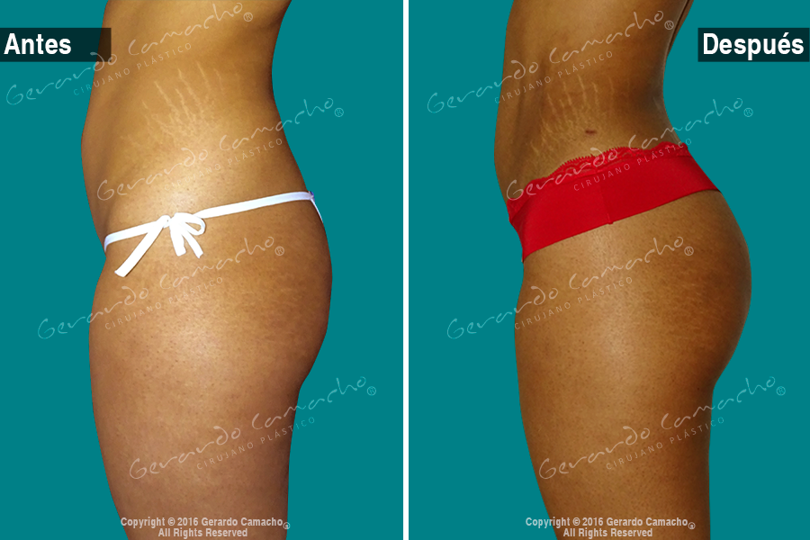 Transformación corporal con gluteoplastia en Bogotá